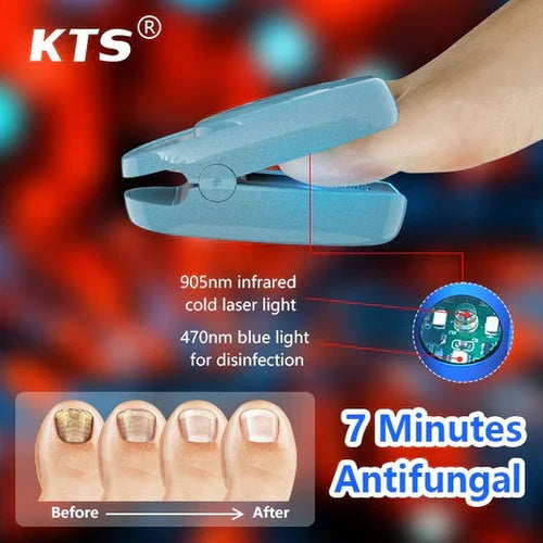 Appareil laser de traitement de la mycose des ongles pour l’onychomycose – Lamylie