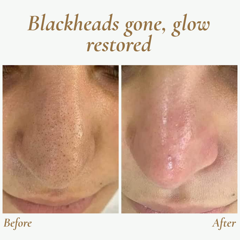 SkinPulse - Professional Ultrasonic Skin Cleansing - Lamylie
