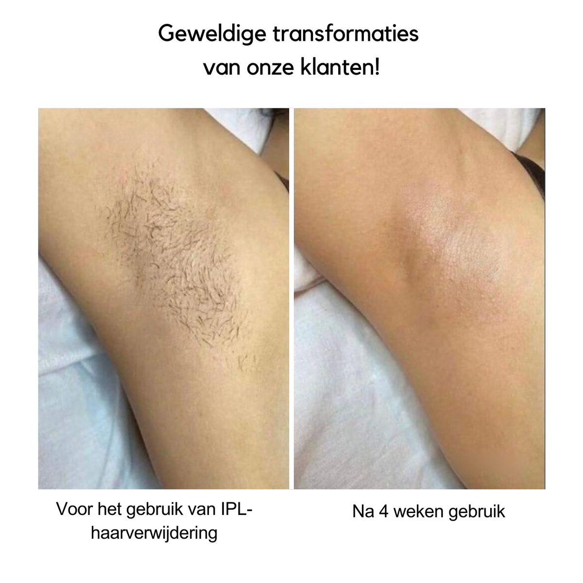 IPL Hair Removal Device for Quick Results and Smooth Skin - Lamylie