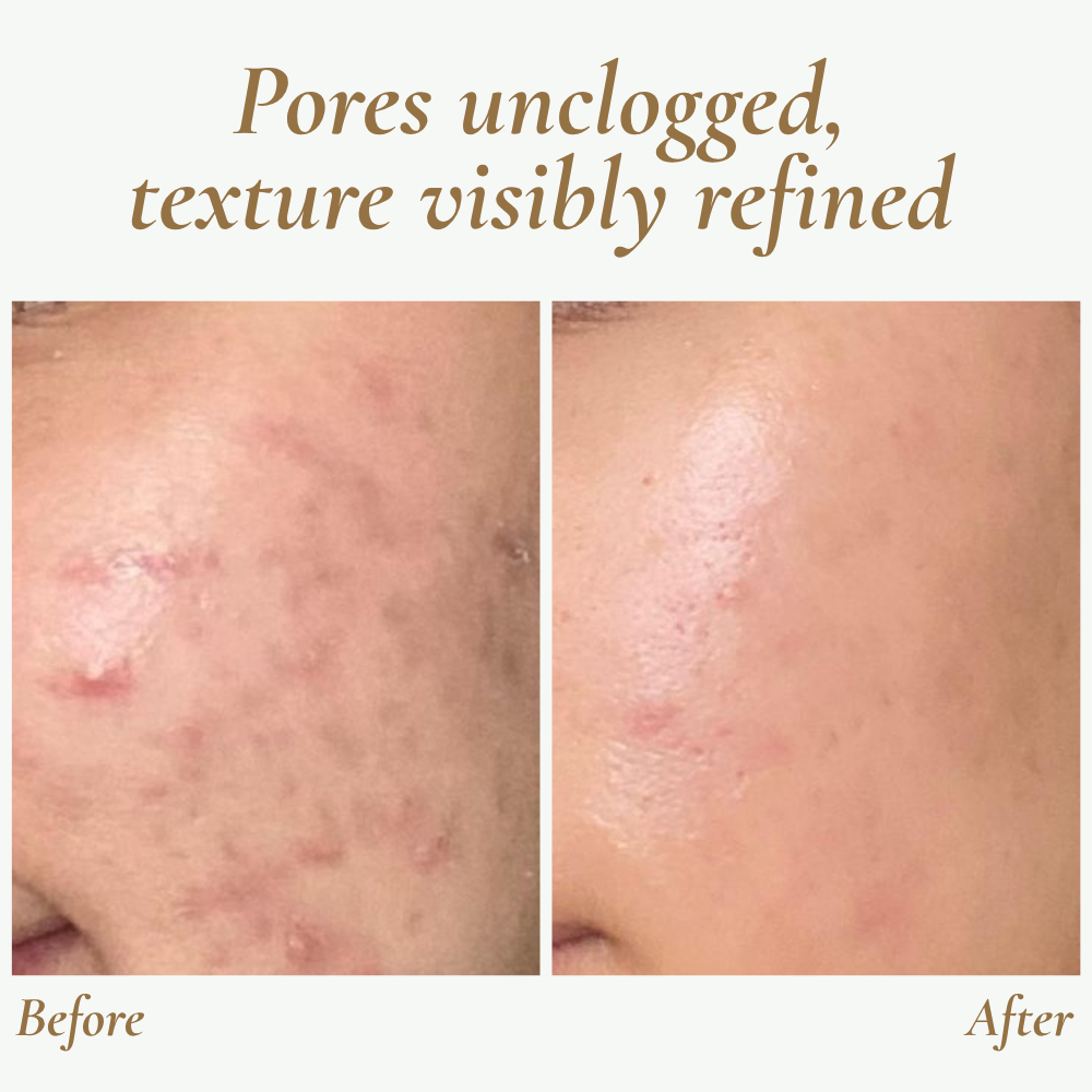 SkinPulse - Professional Ultrasonic Skin Cleansing - Lamylie
