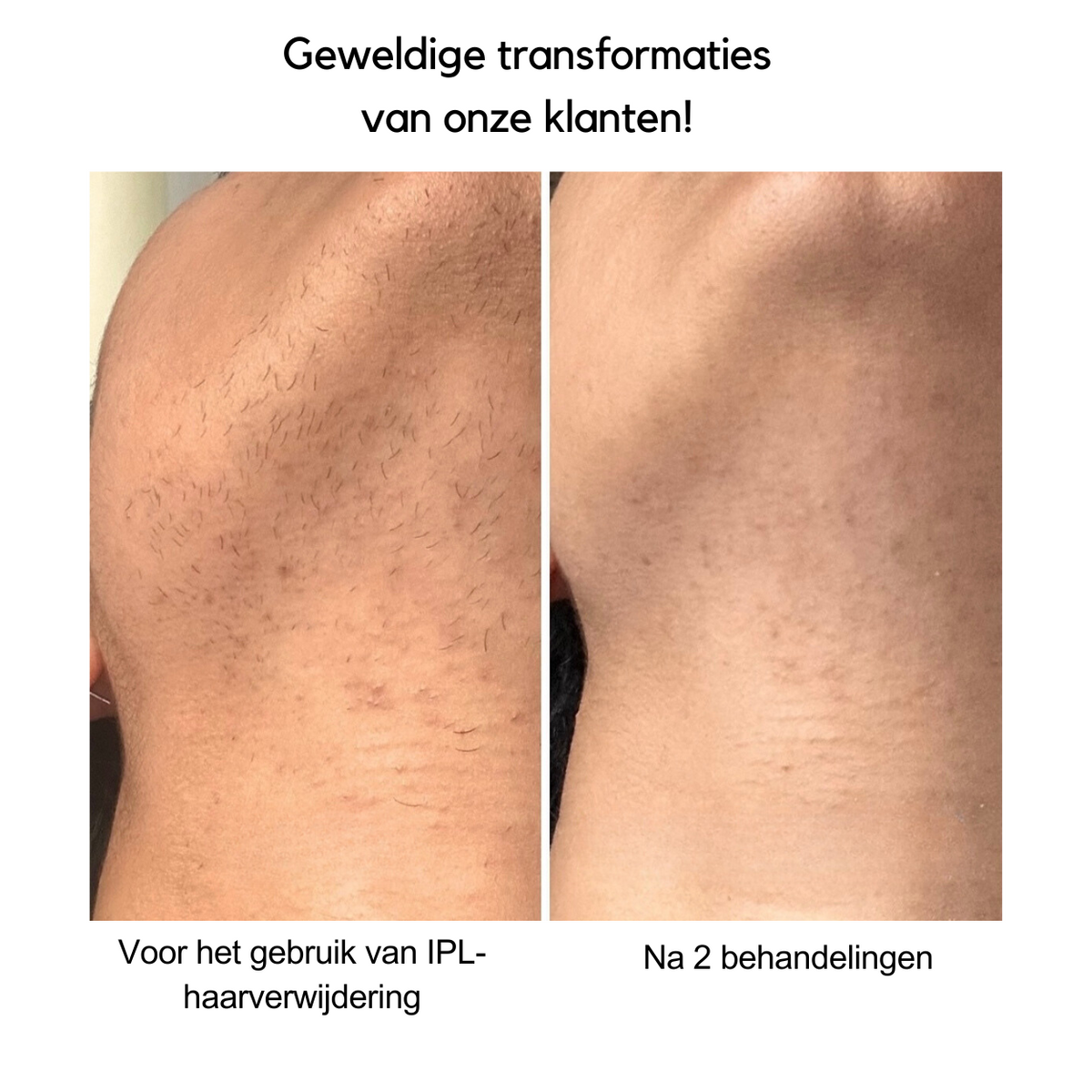 IPL Hair Removal Device for Quick Results and Smooth Skin - Lamylie