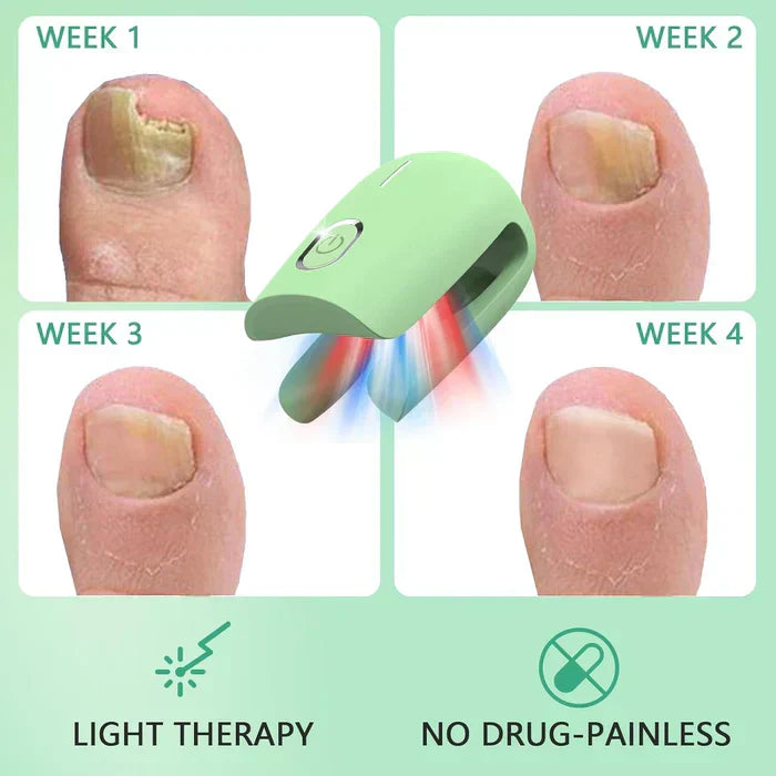 Onychomycosis Treatment Device for Nail Fungus Removal - Lamylie