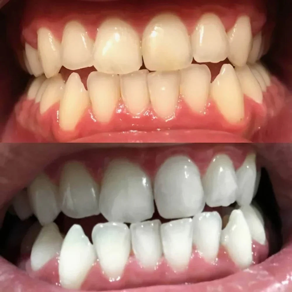 ShinySmile — Instantly Whiten & Boost Confidence | - Lamylie