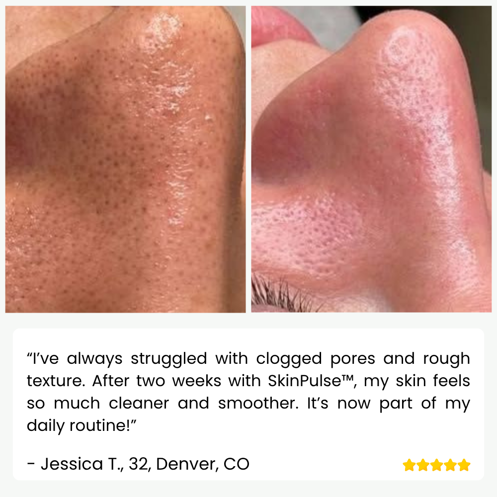 SkinPulse - Professional Ultrasonic Skin Cleansing - Lamylie