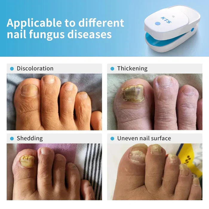 Lasertherapiegerät gegen Nagelpilz – Starterset – Lamylie