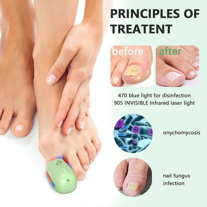 Onychomycosis Treatment Device for Nail Fungus Removal - Lamylie