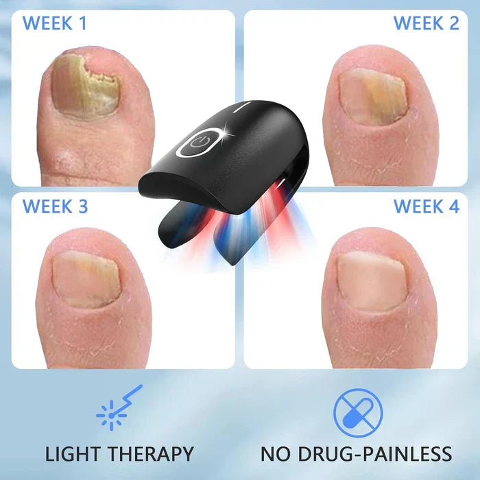Onychomycosis Treatment Device for Nail Fungus Removal - Lamylie
