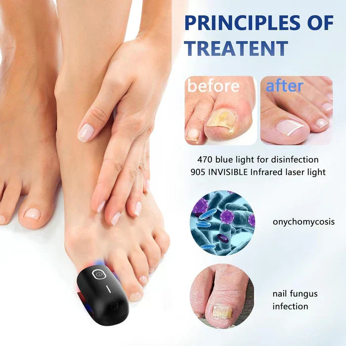 Onychomycosis Treatment Device for Nail Fungus Removal - Lamylie