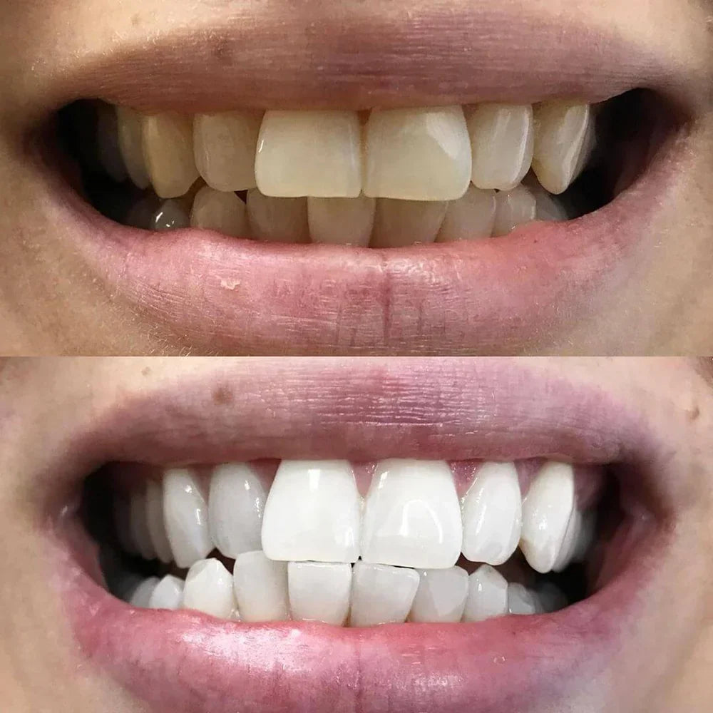 ShinySmile — Instantly Whiten & Boost Confidence | - Lamylie