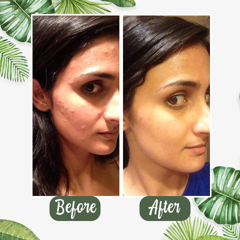 PurifyMist — Unleash Clear, Radiant Skin That Glows with Confidence - Lamylie