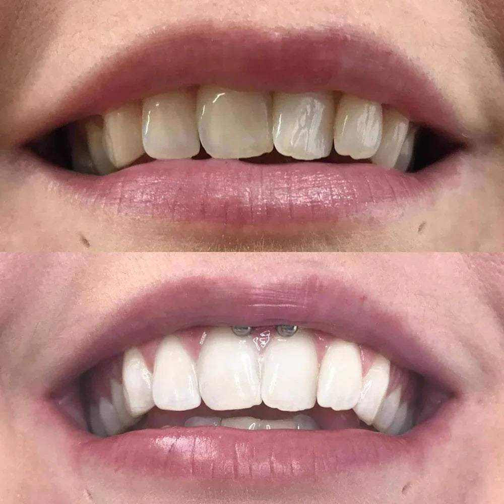 ShinySmile — Instantly Whiten & Boost Confidence | - Lamylie