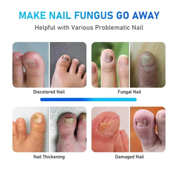 Appareil laser de traitement de la mycose des ongles pour l’onychomycose – Lamylie