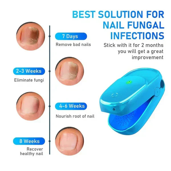 Appareil laser de traitement de la mycose des ongles pour l’onychomycose – Lamylie