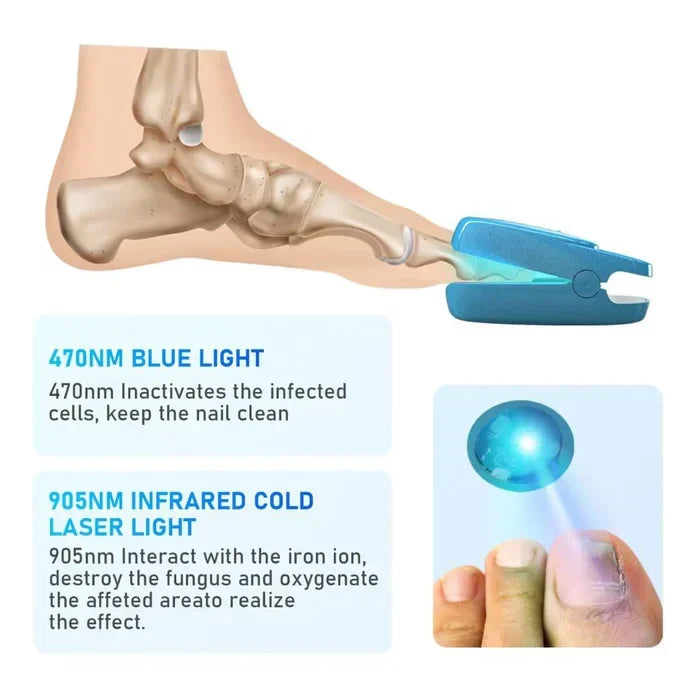 Appareil laser de traitement de la mycose des ongles pour l’onychomycose – Lamylie