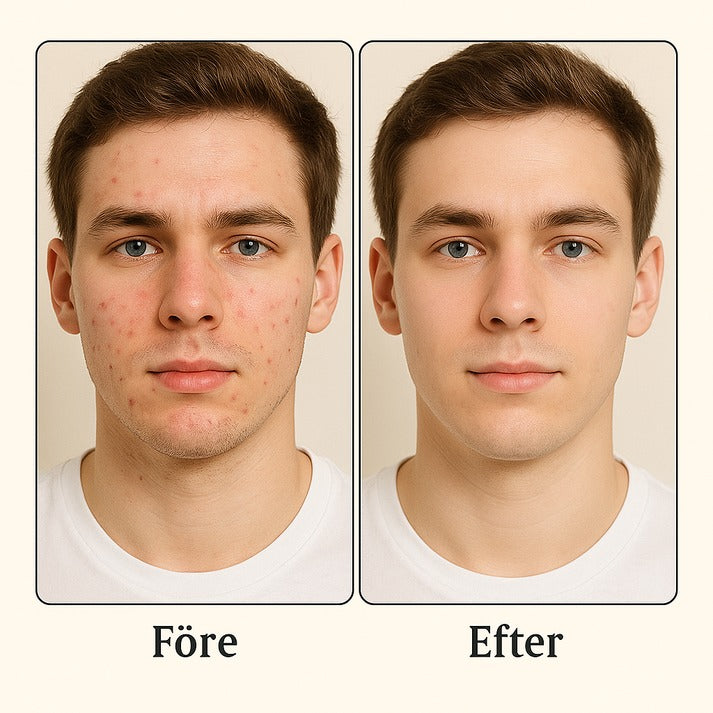 DermaStick | Eliminate acne and blemishes quickly – regain your confidence or your beauty - Lamylie
