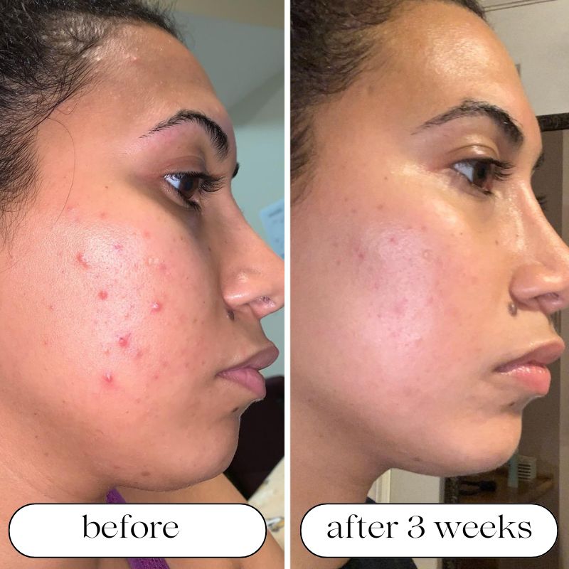 LED Light Therapy Device for At-Home Skin Treatment - Lamylie