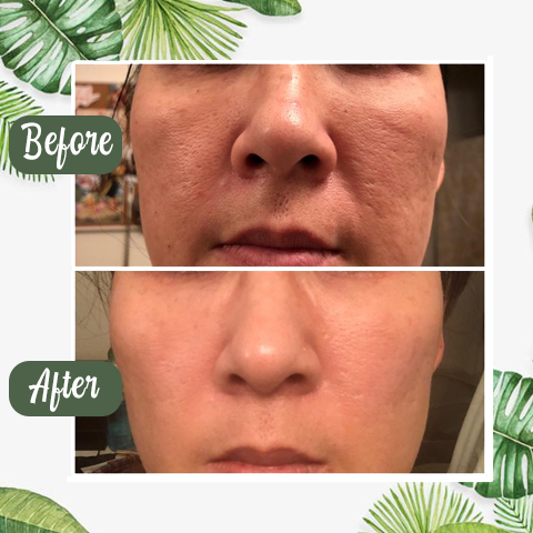 PurifyMist — Unleash Clear, Radiant Skin That Glows with Confidence - Lamylie