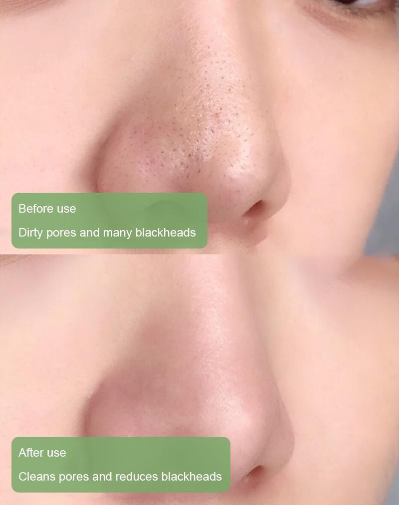 PurifyMist — Unleash Clear, Radiant Skin That Glows with Confidence - Lamylie