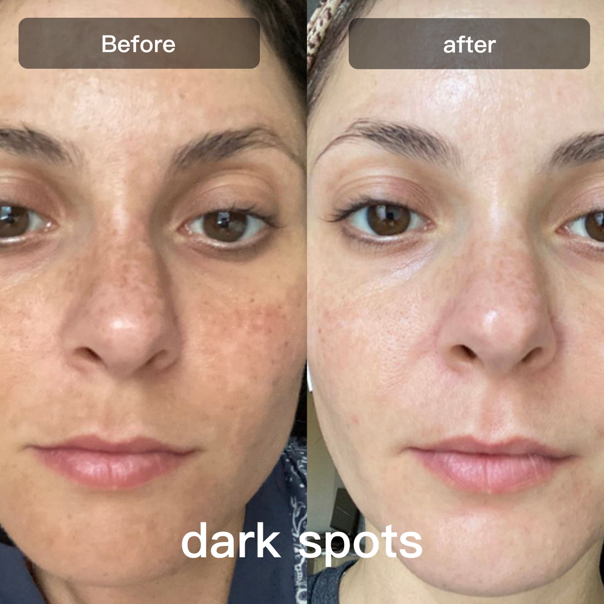 Light Therapy Device for Skin Care on Face and Body - Lamylie