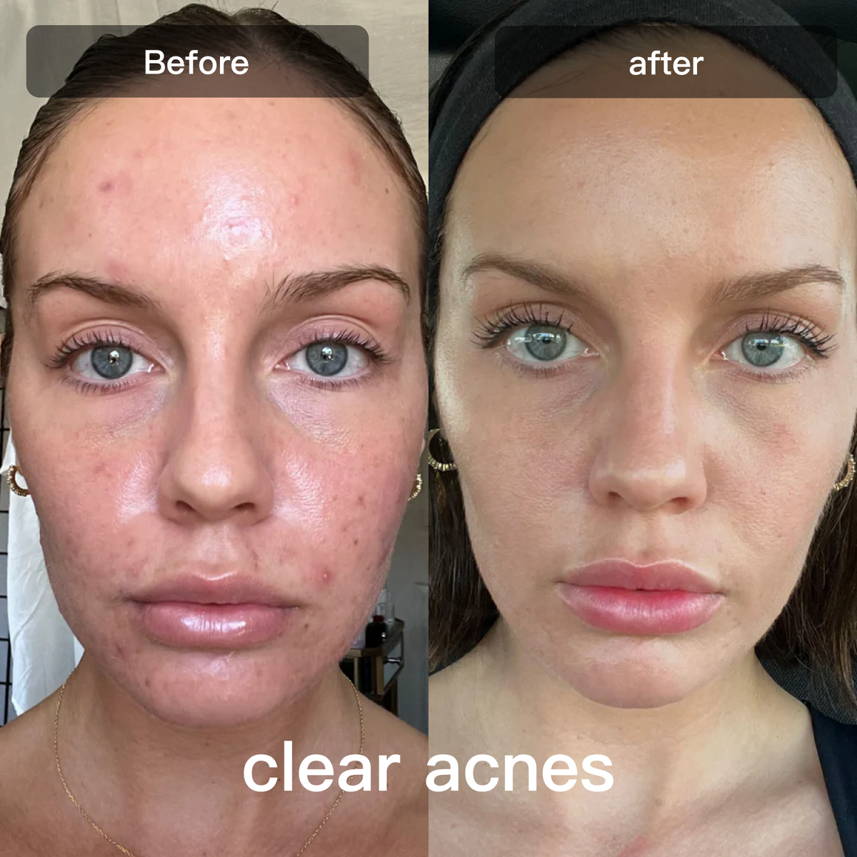 Light Therapy Device for Skin Care on Face and Body - Lamylie